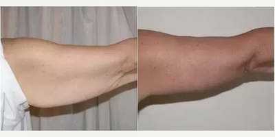 Arm Lift before and after photo