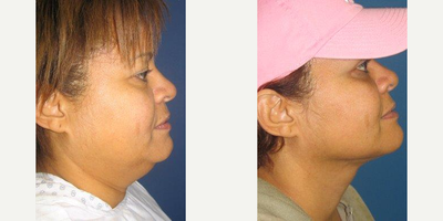 Liposuction before and after photo