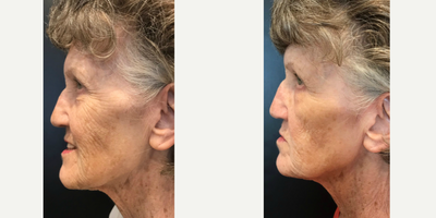 Skinbetter Science before and after photo