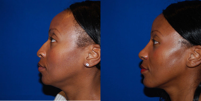 African American Rhinoplasty before and after photo