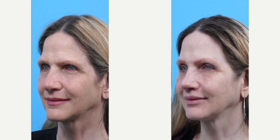 Brow Lift before and after photo