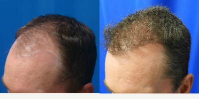 Hair Transplant before and after photo