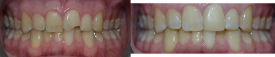 Tooth Repair before and after photo