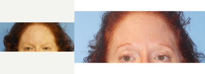 Brow Lift before and after photo