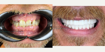 Dental Implants before and after photo