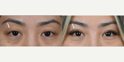 Eyelid Surgery before and after photo
