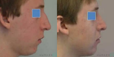Rhinoplasty before and after photo