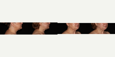 Ultherapy before and after photo