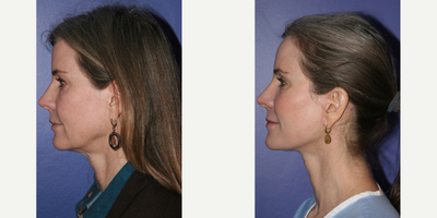 Brow Lift before and after photo