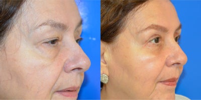 Eyelid Surgery before and after photo