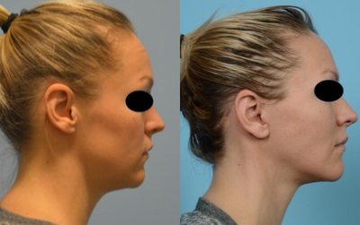 Facelift before and after photo