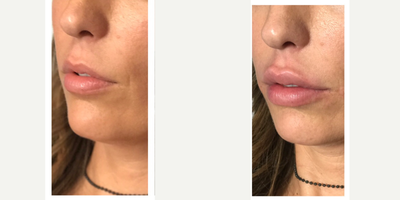 Lip Fillers before and after photo