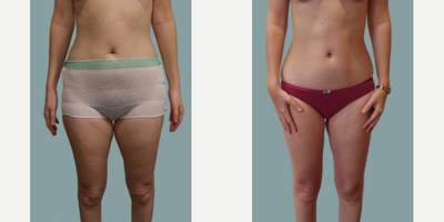 Liposuction before and after photo