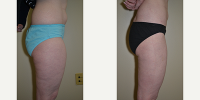 Mommy Makeover before and after photo