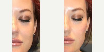 Radiesse before and after photo