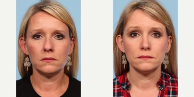 Rhinoplasty before and after photo