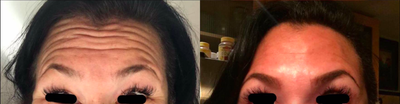 Botox before and after photo