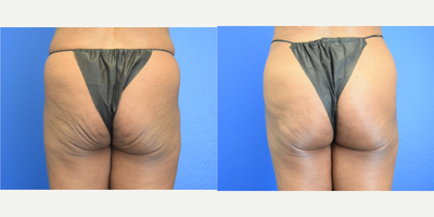 Butt Lift before and after photo