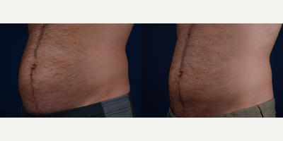 CoolSculpting before and after photo