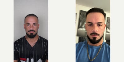 Hair Transplant before and after photo