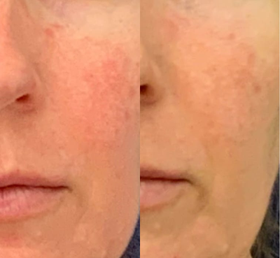 HydraFacial before and after photo