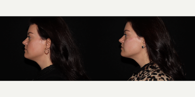 Juvederm before and after photo