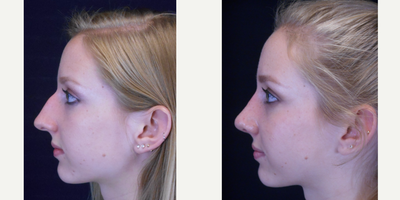 Rhinoplasty before and after photo