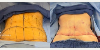 Tummy Tuck before and after photo