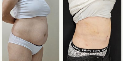 Vaser Liposuction before and after photo