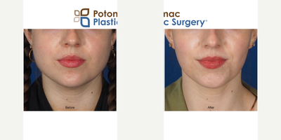 Botox before and after photo