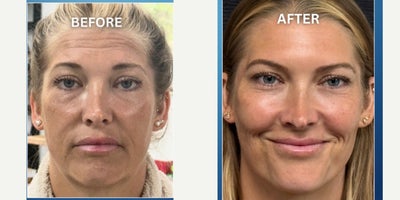 Daxxify before and after photo
