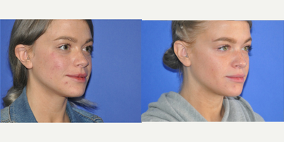 Eyelid Surgery before and after photo