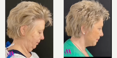 Neck Lift before and after photo