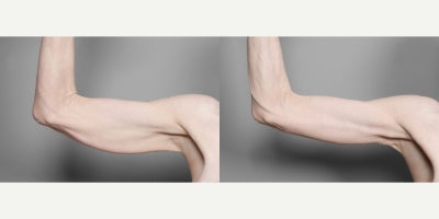 Arm Lift before and after photo