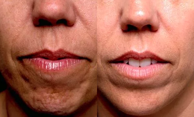 Botox before and after photo