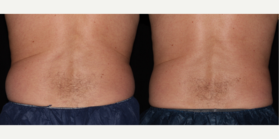 CoolSculpting before and after photo