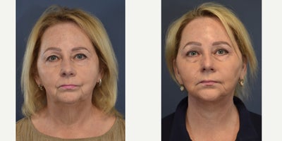 Facelift before and after photo