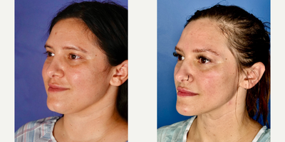 FaceTite before and after photo