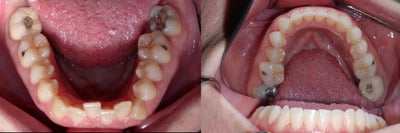 Invisalign before and after photo