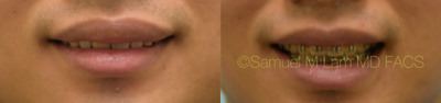 Lip Reduction before and after photo