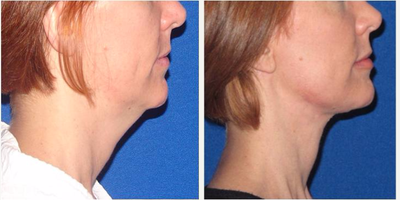 Neck Lift before and after photo
