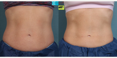 CoolSculpting before and after photo