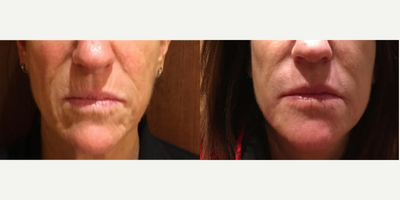 Vollure before and after photo