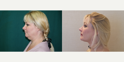 Chin Liposuction before and after photo