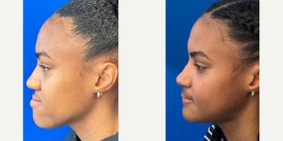 Facial Reconstructive Surgery before and after photo