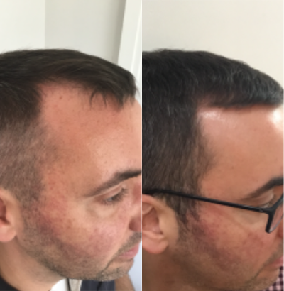 Hair Loss Treatment before and after photo