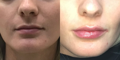 Lip Fillers before and after photo