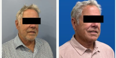 Neck Lift before and after photo