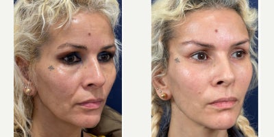 Brow Lift before and after photo