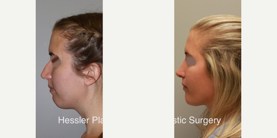 Chin Implant before and after photo